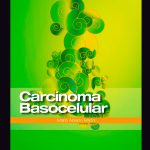 Carcinoma basocelular