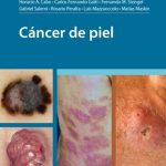 Cancer de Piel