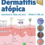 Dermatitis atopica