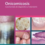 Onicomicosis Guia ilustrada de diagnóstico y tratamiento