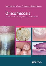Onicomicosis Guia ilustrada de diagnóstico y tratamiento
